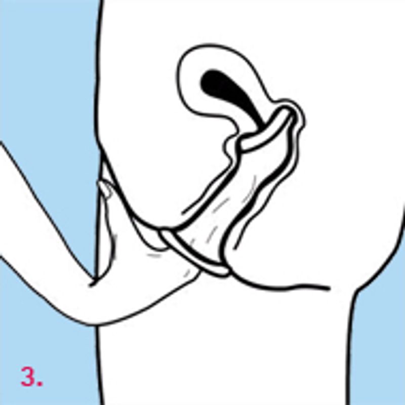 Female Condom Femidom 3 Piece - Four Seasons